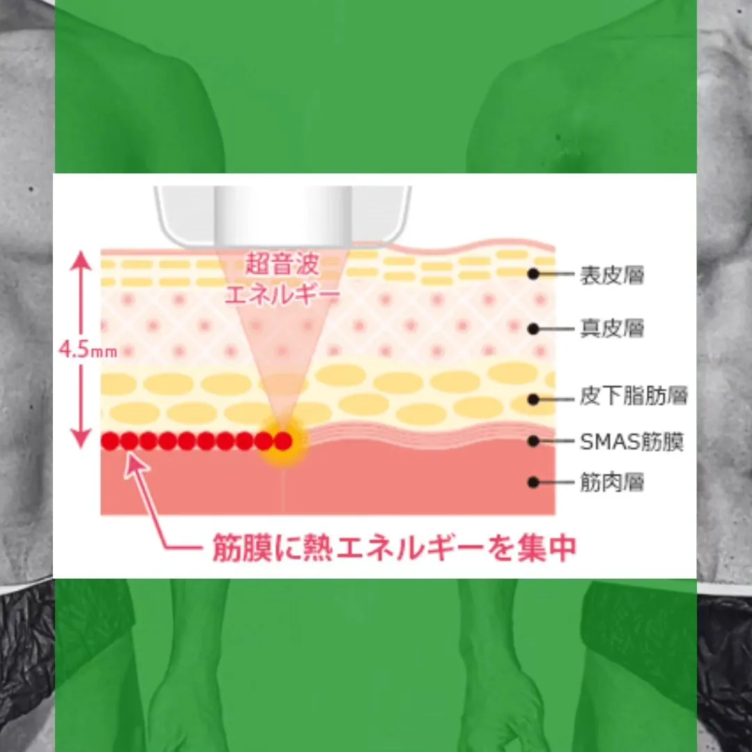 【今、悪い意味で話題のハイフ(HIFU)について📢】